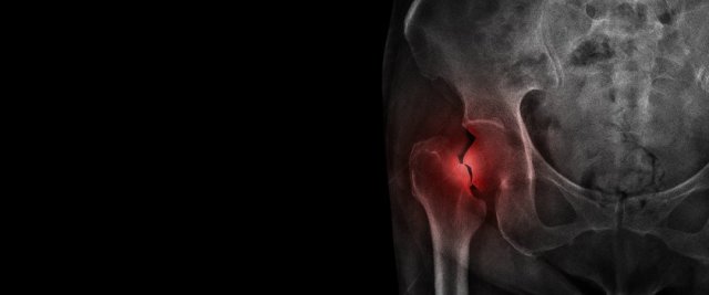Czym jest osteoporoza?